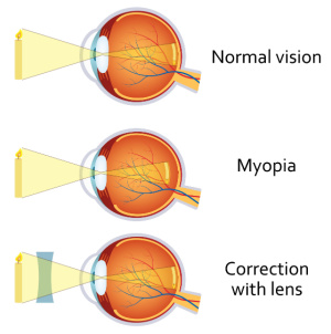 Myopia Diagram